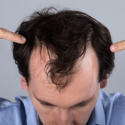 La pérdida del cabello
